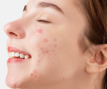 ЛЕЧЕНИЯ АКНЕ И ПОСТАКНЕ